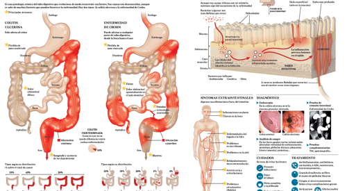 2011_img_preview_infografico_EII <p>Imagen preview del infográfico sobre la enfermedad inflamatoria intestinal </p>
